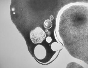 M,49y. | blood - dyserythropoetic anemia M,49y. | blood - dyserythropoetic anemia